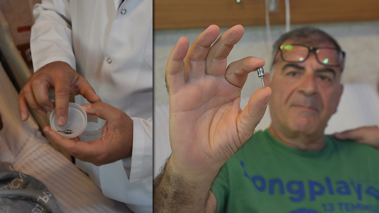 Akciğerden Çıkan Diş İmplantı Şoku! Doktorlar Bile Hayret Etti