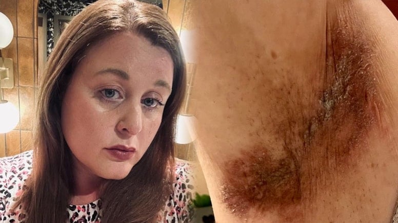 Mitchum roll-on krizi: Üç kadın Revlon’a cilt yanığı davası açtı